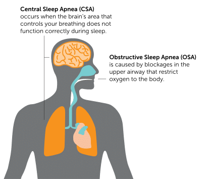 Types of Sleep Apnea