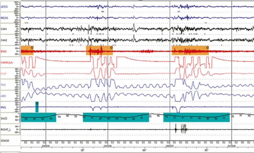 UNDERSTANDING YOUR IN-LAB SLEEP STUDY RESULTS | Respicardia