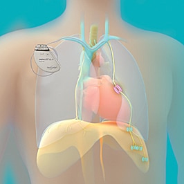 remede-EX-L-system