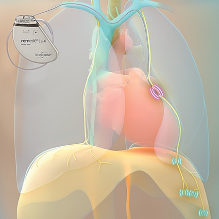 remede-EX-L-system